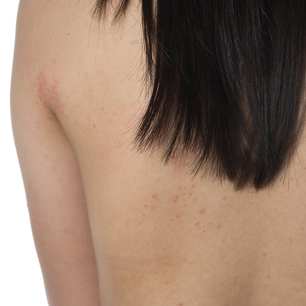 Eczema Eczema