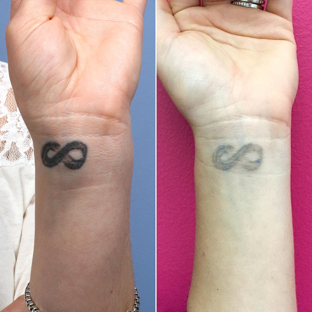 What It's Like to Have a Tattoo Removed POPSUGAR Beauty