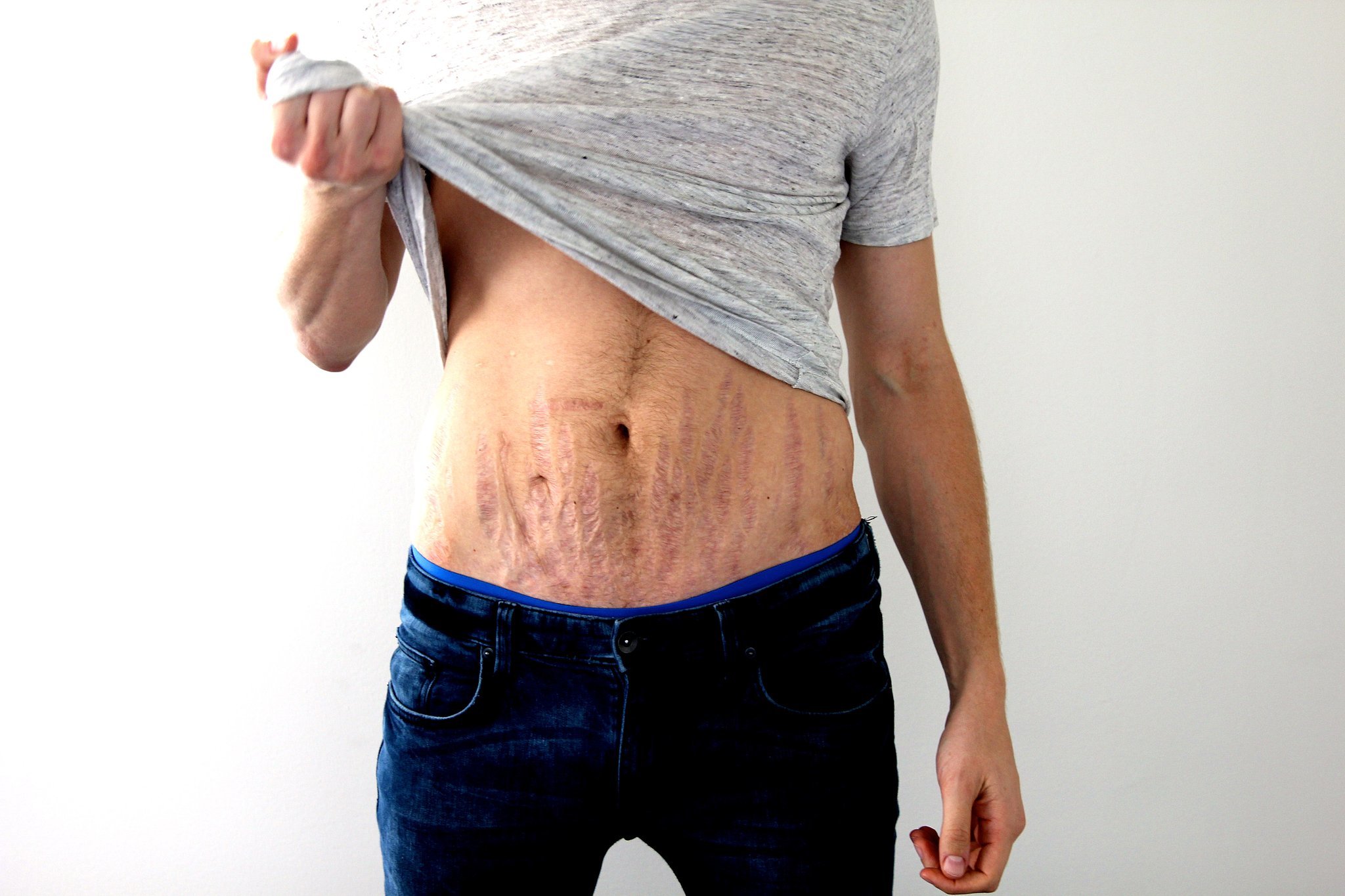 Those who wear scars look at them every day — sometimes they define