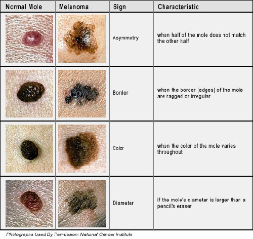 4 Warning Signs of Skin Cancer | POPSUGAR Fitness